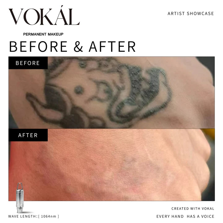 Tattoo before and after case 6